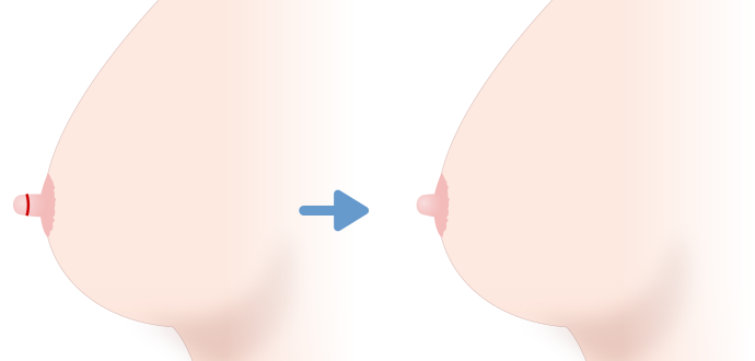 乳頭(乳首)縮小術